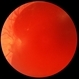 Acute Subhyaloid Hemorrhage CF Acute Subhyaloid Hemorrhage CF